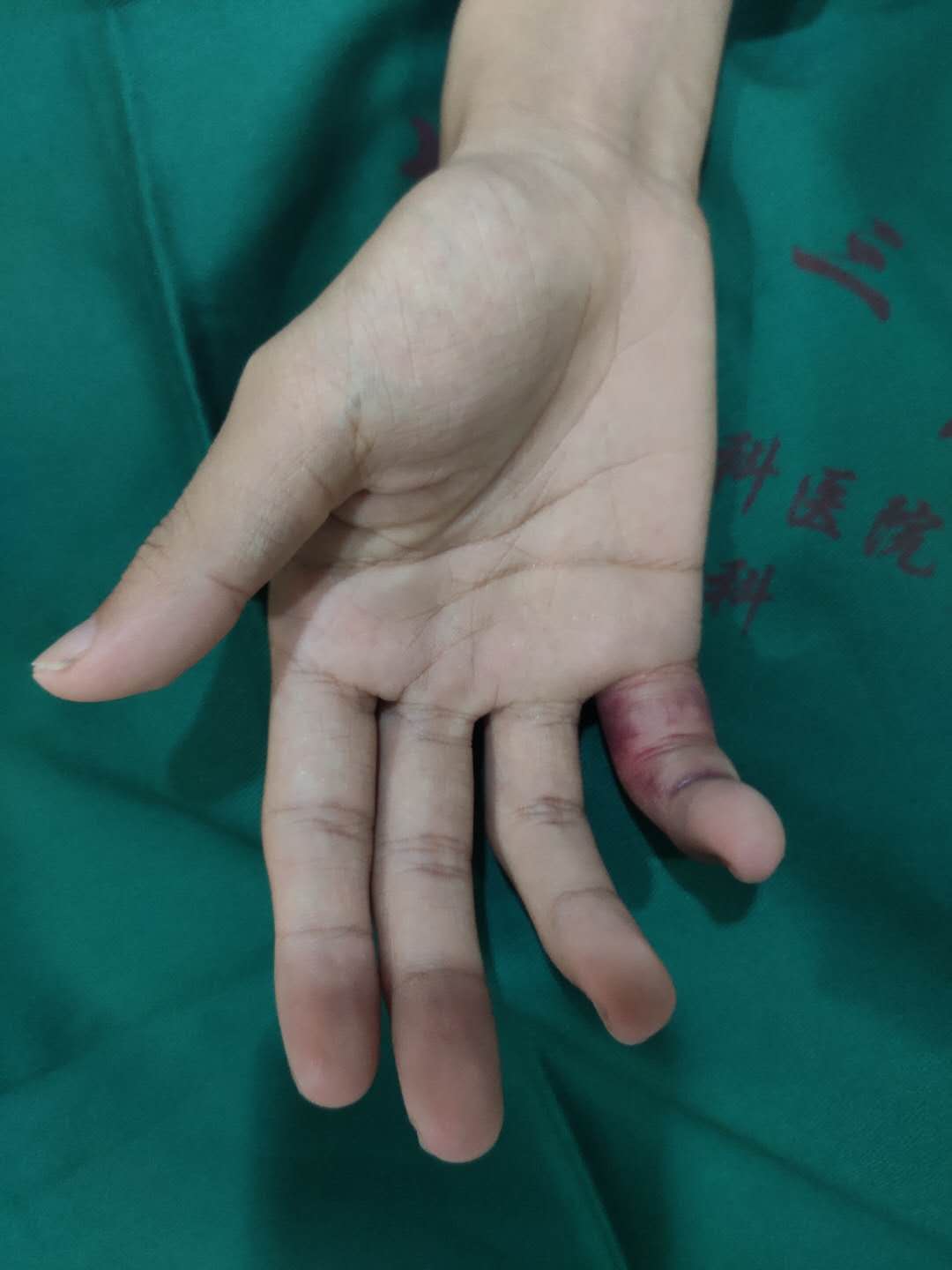 手指被篮球砸了怎么判断骨折(如果你家孩子爱打篮球，那么必须教会他手指被戳伤怎么处理)